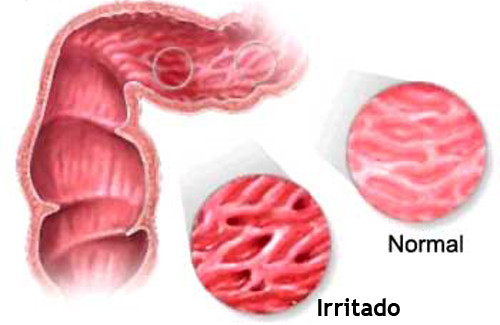 Síndrome do Intestino Irritável (SII)