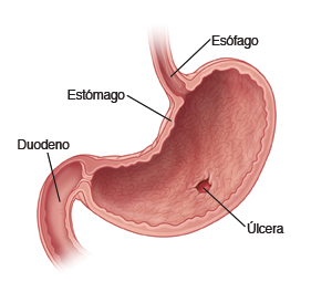Úlcera Pépticas